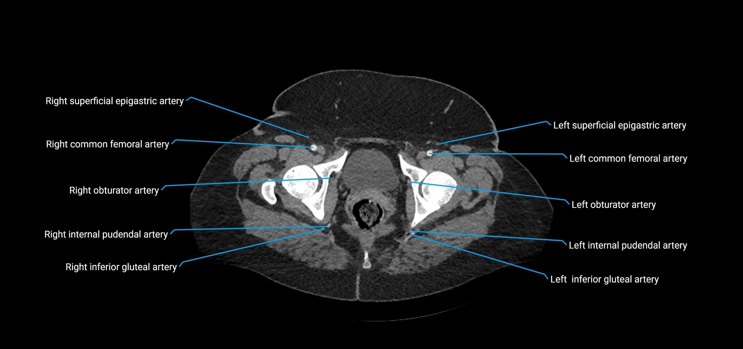 CTA abdomen axial cross sectional anatomy labelled image_250 (2).webp